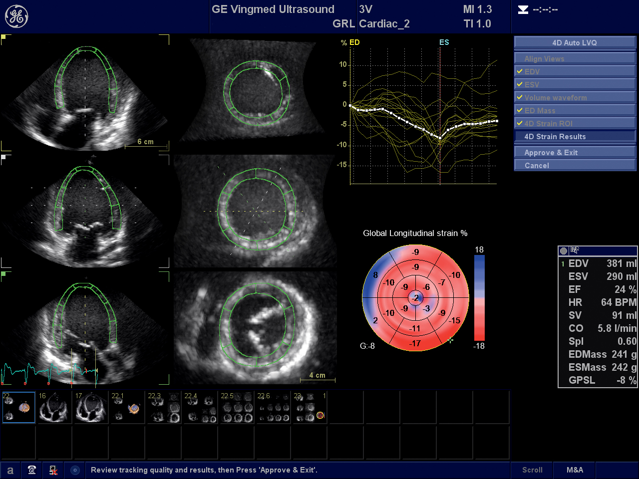 Assessing Cardiotoxicity Due to Cancer Therapy | DAIC